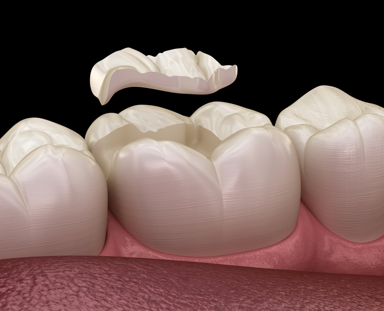 Inlay ceramic crown fixation over tooth. Medically accurate 3D illustration of human teeth treatment