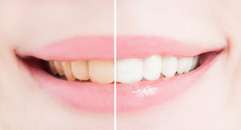 Whiten teeth after bleaching or whitening