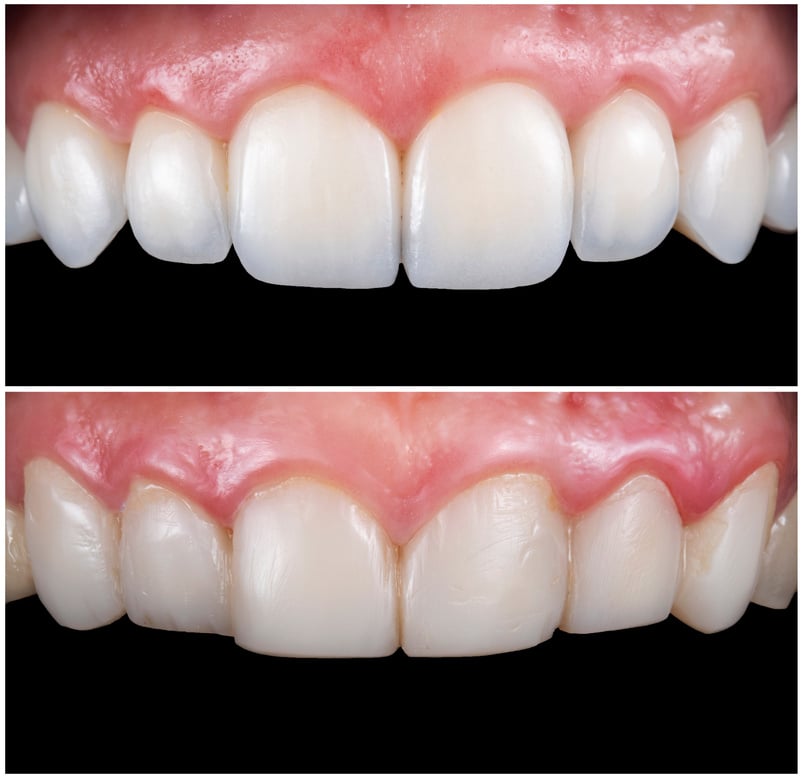 before and after picture for dental tretment by emax press ceramic veneers