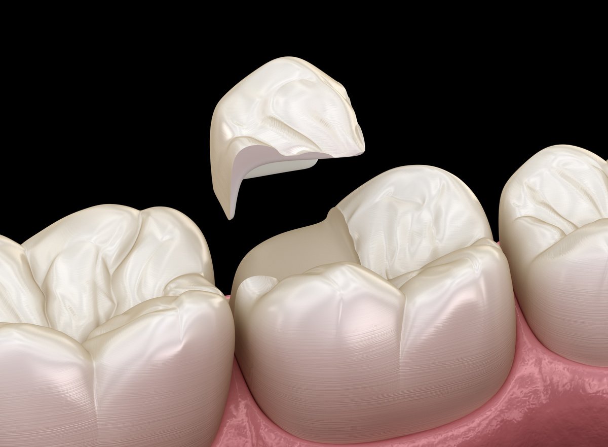 Onlay ceramic crown fixation over tooth. Medically accurate 3D illustration of human teeth treatment