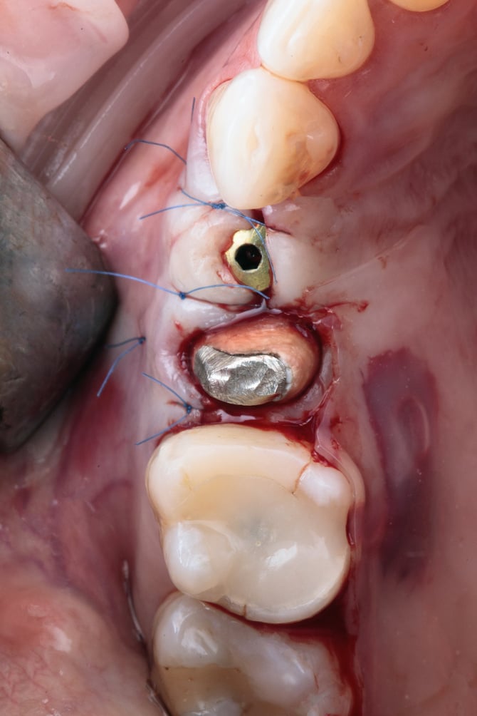 sutured gum with shaper after implantation