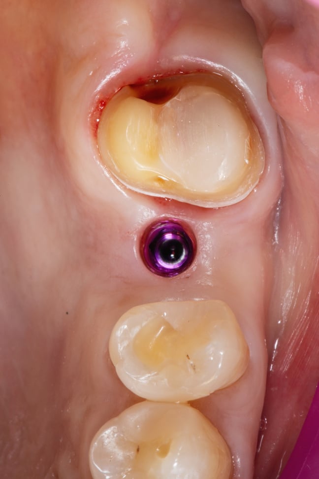 prepared tooth for a crown and an implant for a crown