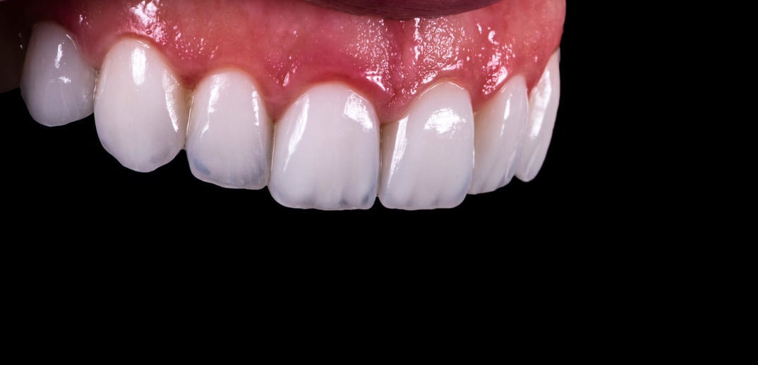 press ceramic crowns and veneers b1 color